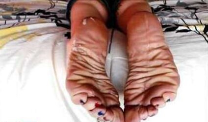 Puckered feet
