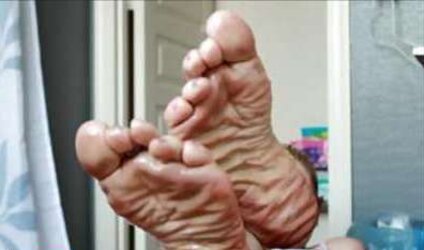 Puckered feet