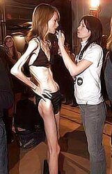 Anorexic Models